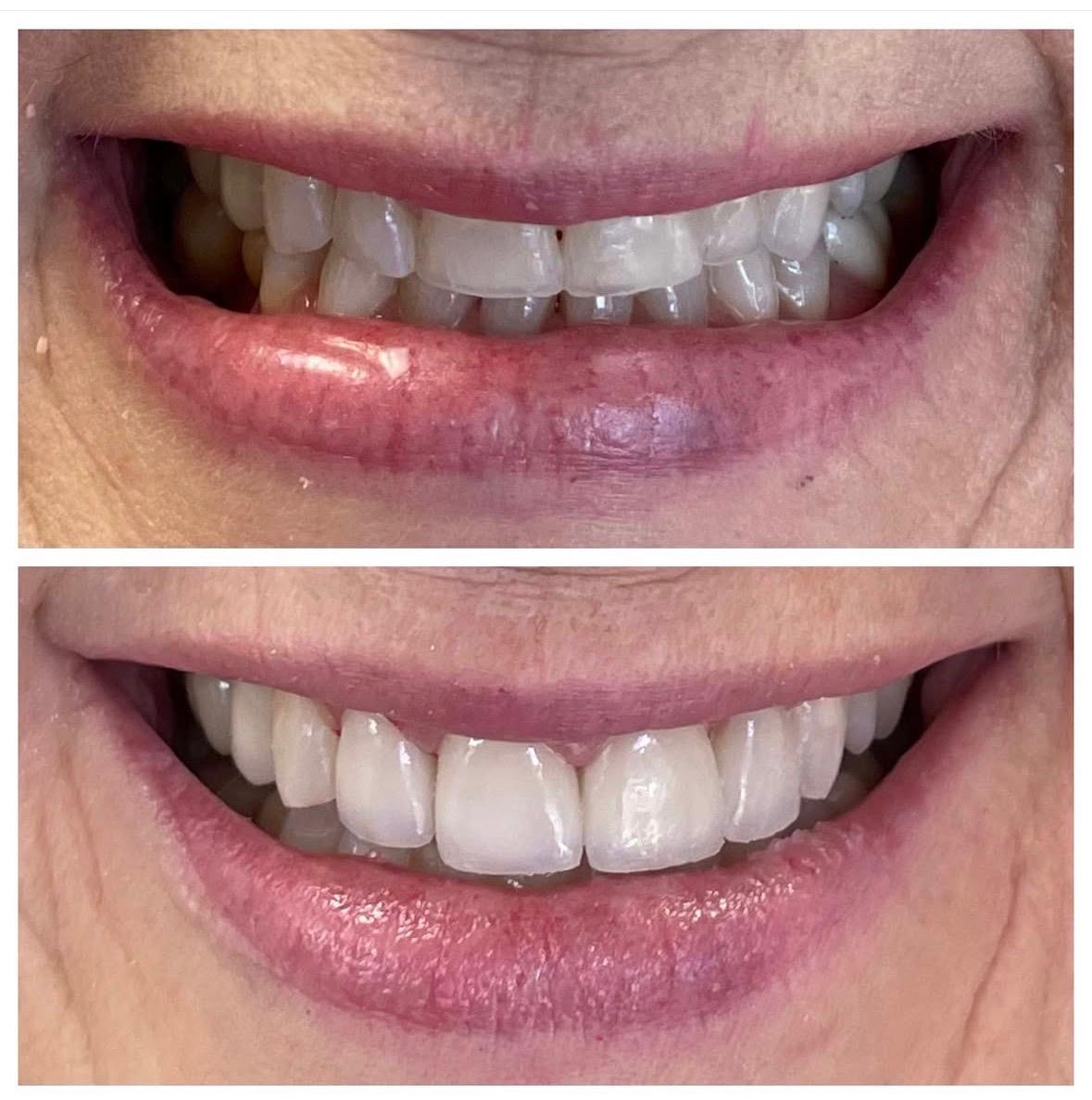 Before and after smile makeover