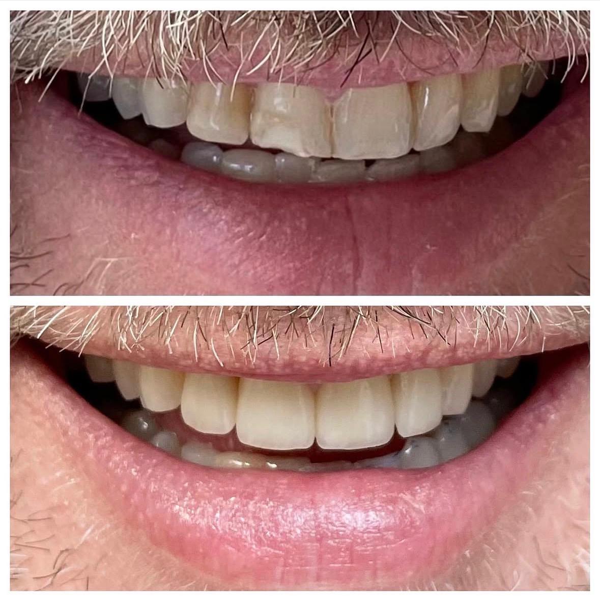 Before and after smile makeover