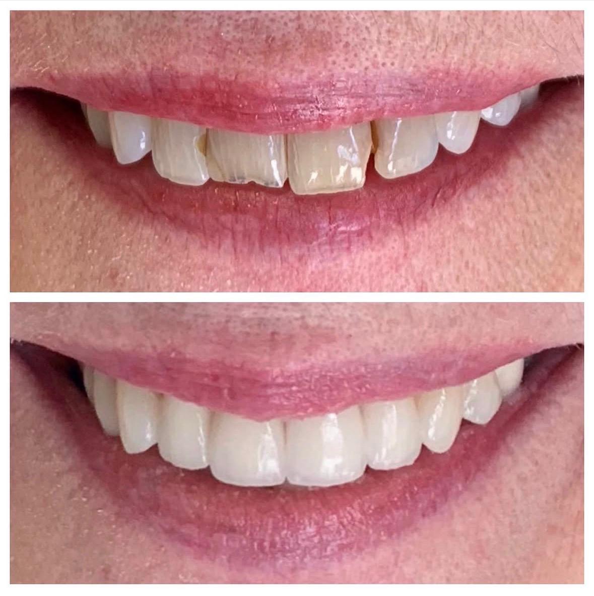 Before and after smile makeover