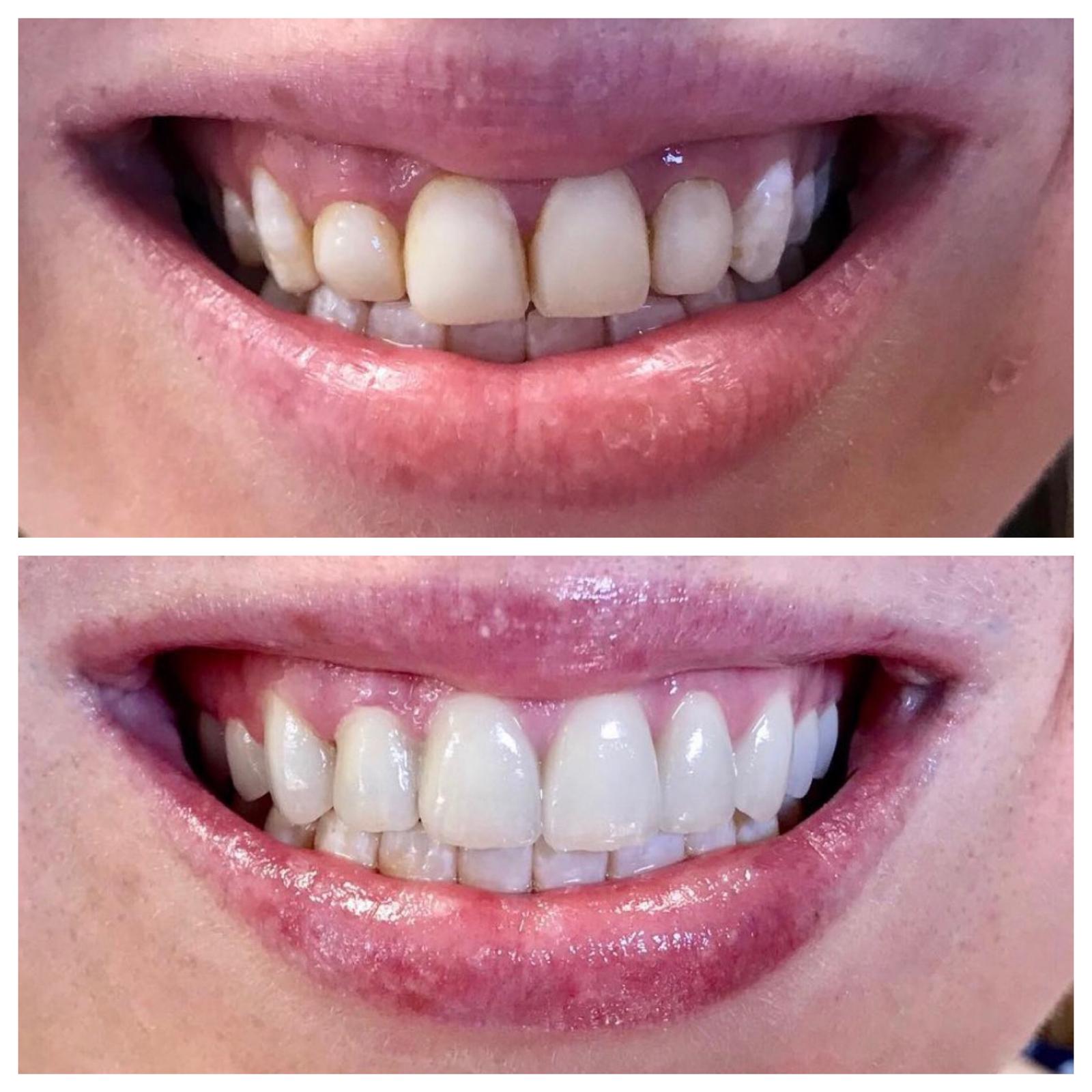 Before and after smile makeover