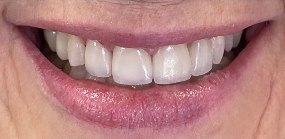 Patient smile after treatment