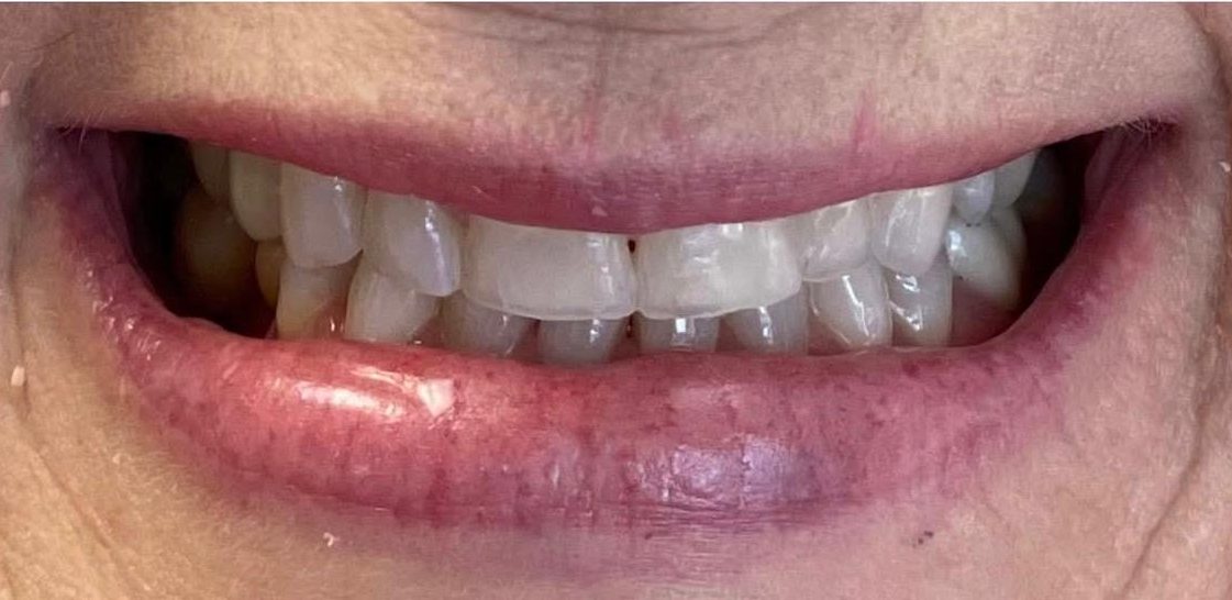 Patient smile before treatment