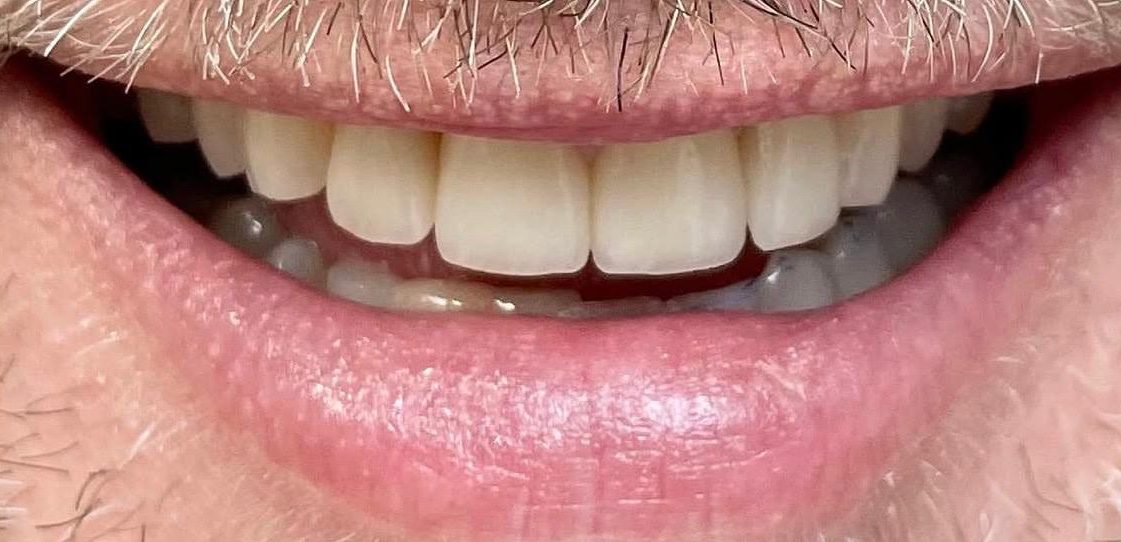 Patient smile after treatment
