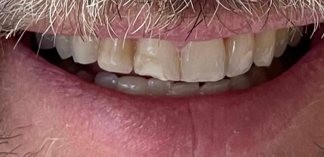 Patient smile before treatment