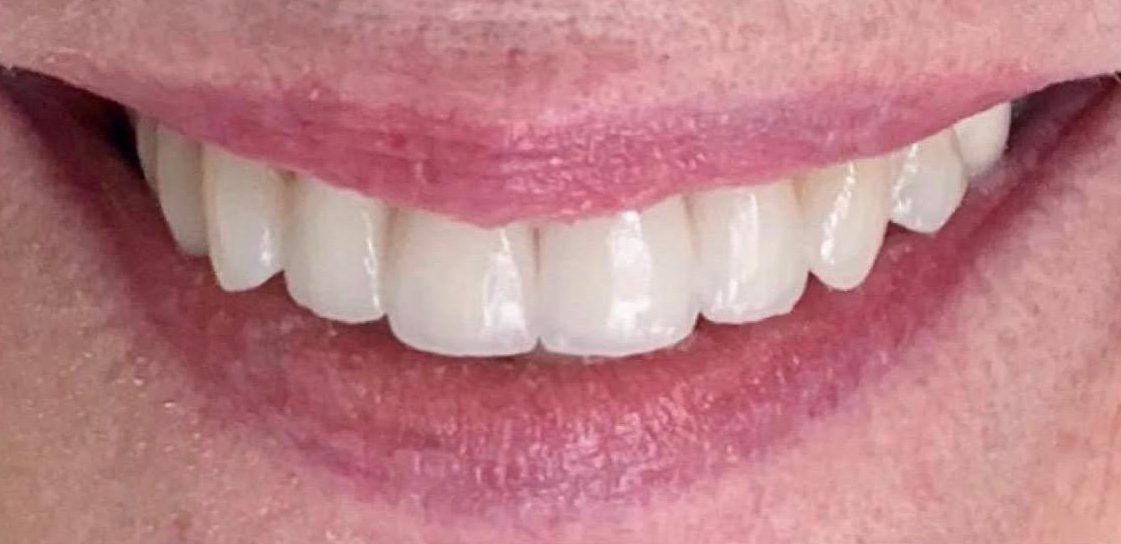 Patient smile after treatment