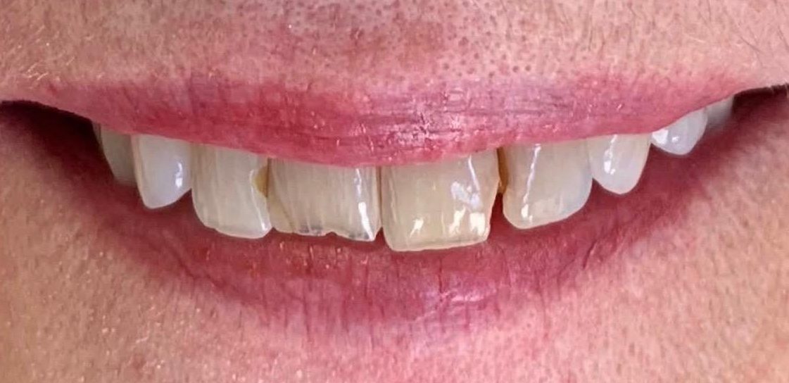 Patient smile before treatment