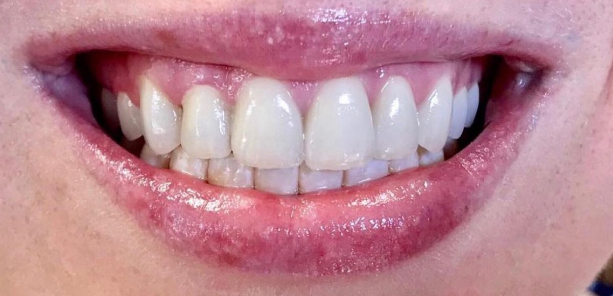 Patient smile after treatment