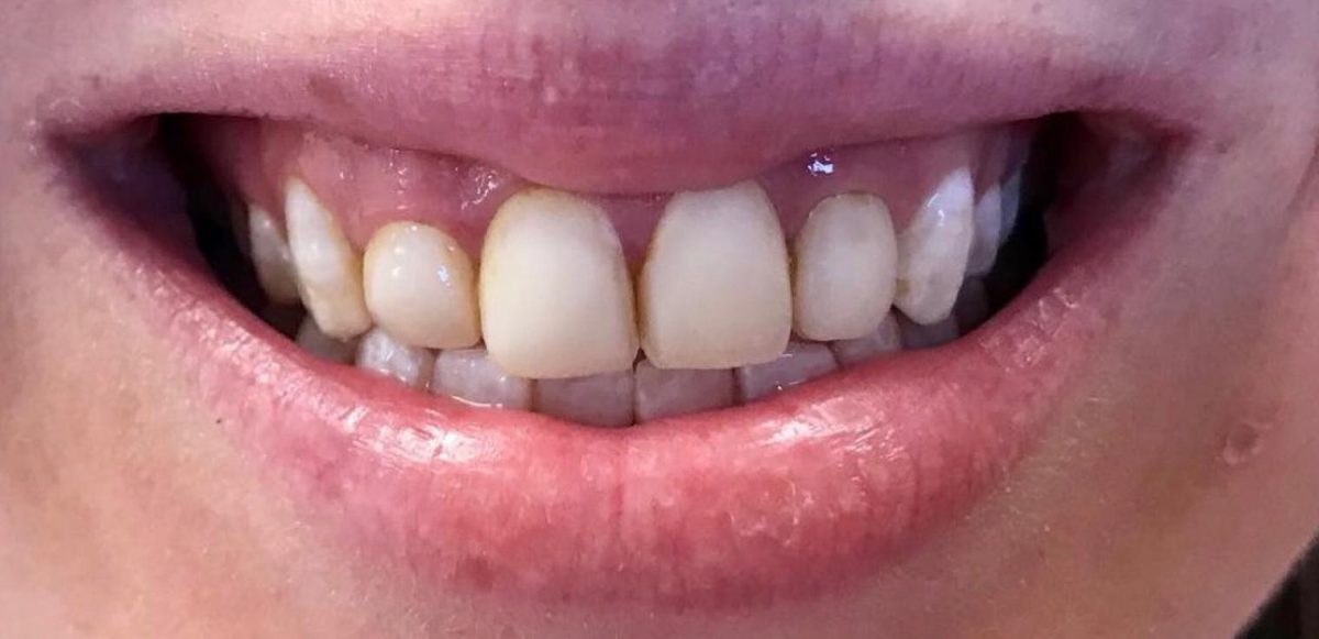 Patient smile before treatment